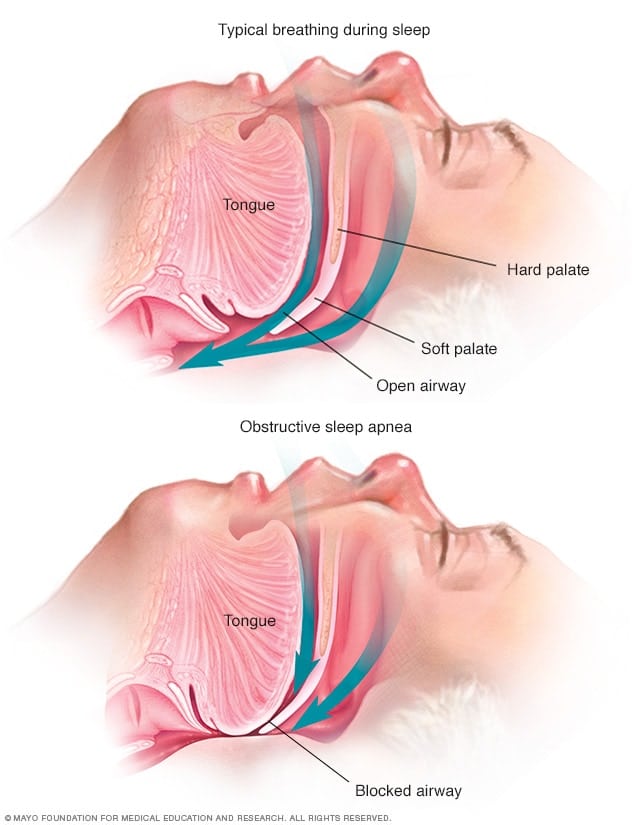 What Causes Sleep Apnea? What Causes Sleep Apnea?