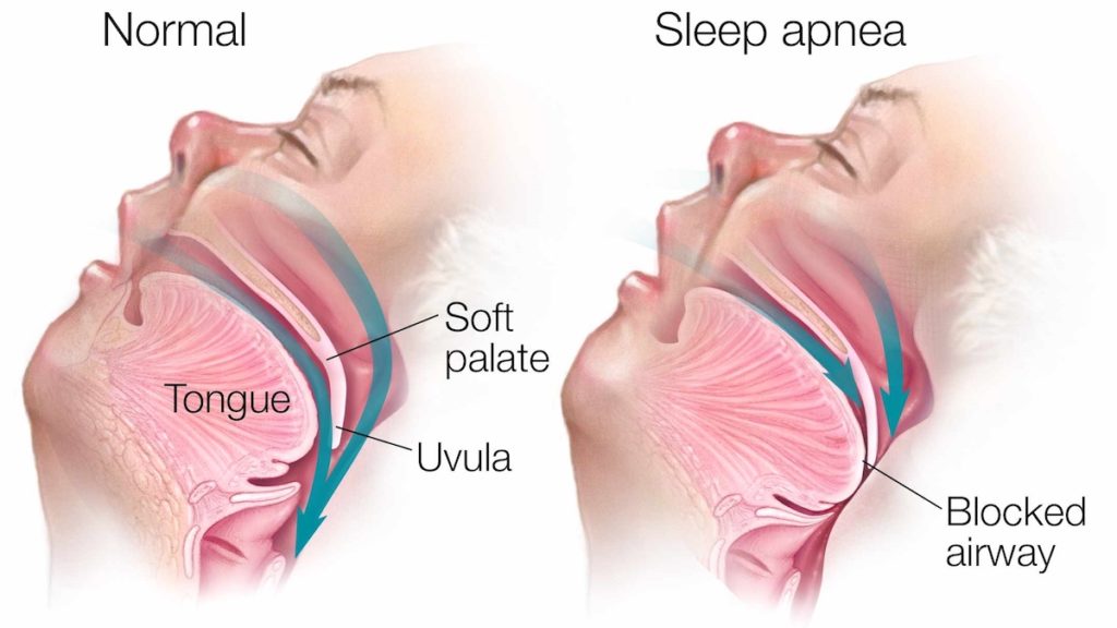 What Is Sleep Apnea?